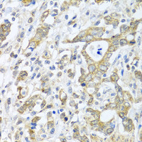 Immunohistochemistry of paraffin-embedded Human gastric cancer using TICAM1 Polyclonal Antibody at dilution of 1:100 (40x lens) .