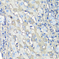 Immunohistochemistry of paraffin-embedded Human liver cancer using Albumin Polyclonal Antibody at dilution of 1:100 (40x lens) .