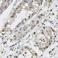 Immunohistochemistry of paraffin-embedded Human gastric cancer using CA9 Polyclonal Antibody at dilution of 1:100 (40x lens) .