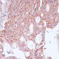Immunohistochemistry of paraffin-embedded Human colon carcinoma using RPL30 Polyclonal Antibody at dilution of 1:100 (40x lens) .