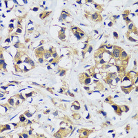 Immunohistochemistry of paraffin-embedded Human breast cancer using CAMLG Polyclonal Antibody at dilution of 1:100 (40x lens) .