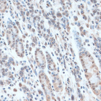 Immunohistochemistry of paraffin-embedded Human gastric cancer using ZNF707 Polyclonal Antibody at dilution of 1:100 (40x lens) .