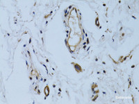 Immunohistochemistry of paraffin-embedded Human colon carcinoma using MCAM Polyclonal Antibody at dilution of 1:100 (40x lens) .