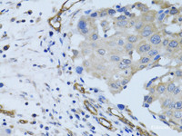 Immunohistochemistry of paraffin-embedded Human breast cancer using MCAM Polyclonal Antibody at dilution of 1:100 (40x lens) .