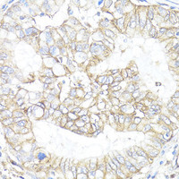 Immunohistochemistry of paraffin-embedded Human lung cancer using ATP1B1 Polyclonal Antibody at dilution of 1:100 (40x lens) .