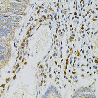 Immunohistochemistry of paraffin-embedded Human colon carcinoma using CDA Polyclonal Antibody at dilution of 1:100 (40x lens) .