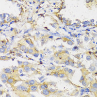 Immunohistochemistry of paraffin-embedded Human lung cancer using HLA-DPB1 Polyclonal Antibody at dilution of 1:100 (40x lens) .
