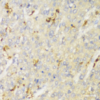 Immunohistochemistry of paraffin-embedded Human liver cancer using HLA-DPB1 Polyclonal Antibody at dilution of 1:100 (40x lens) .