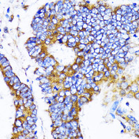 Immunohistochemistry of paraffin-embedded Human colon carcinoma using MRPL13 Polyclonal Antibody at dilution of 1:100 (40x lens) .