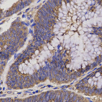 Immunohistochemistry of paraffin-embedded Human rectum cancer using EPHX2 Polyclonal Antibody at dilution of 1:200 (40x lens) .