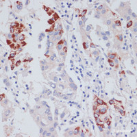 Immunohistochemistry of paraffin-embedded Human liver cancer using VASP Polyclonal Antibody at dilution of 1:100 (40x lens) .