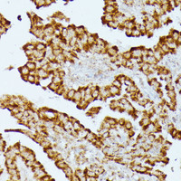 Immunohistochemistry of paraffin-embedded Human thyroid cancer using HMGCS2 Polyclonal Antibody at dilution of 1:100 (40x lens) .