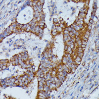 Immunohistochemistry of paraffin-embedded Human colon carcinoma using HMGCS2 Polyclonal Antibody at dilution of 1:100 (40x lens) .