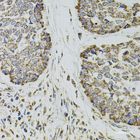 Immunohistochemistry of paraffin-embedded Human esophageal cancer using SELP Polyclonal Antibody at dilution of 1:100 (40x lens) .