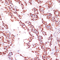 Immunohistochemistry of paraffin-embedded Human thyroid cancer using RPL24 Polyclonal Antibody at dilution of 1:100 (40x lens) .