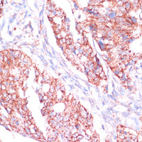 Immunohistochemistry of paraffin-embedded Human colon carcinoma using RPL24 Polyclonal Antibody at dilution of 1:100 (40x lens) .