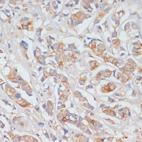 Immunohistochemistry of paraffin-embedded Human breast cancer using DLL1 Polyclonal Antibody at dilution of 1:100 (40x lens) .