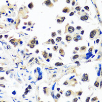 Immunohistochemistry of paraffin-embedded Human lung cancer using CAND1 Polyclonal Antibody at dilution of 1:100 (40x lens) .
