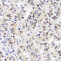 Immunohistochemistry of paraffin-embedded Human uterine cancer using CAND1 Polyclonal Antibody at dilution of 1:100 (40x lens) .