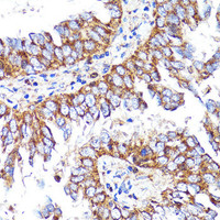 Immunohistochemistry of paraffin-embedded Human lung cancer using CNR1 Polyclonal Antibody at dilution of 1:150 (40x lens) .