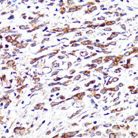 Immunohistochemistry of paraffin-embedded Human stomach cancer using CNR1 Polyclonal Antibody at dilution of 1:150 (40x lens) .