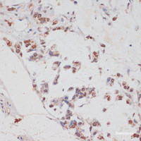 Immunohistochemistry of paraffin-embedded Human gastric cancer using HTATSF1 Polyclonal Antibody at dilution of 1:100 (40x lens) .