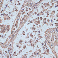 Immunohistochemistry of paraffin-embedded Human lung cancer using SNW1 Polyclonal Antibody at dilution of 1:100 (40x lens) .