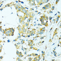 Immunohistochemistry of paraffin-embedded Human breast cancer using CYP2B6 Polyclonal Antibody at dilution of 1:100 (40x lens) .