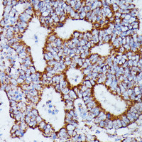 Immunohistochemistry of paraffin-embedded Human colon carcinoma using IDH3A Polyclonal Antibody at dilution of 1:100 (40x lens) .