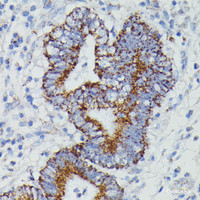 Immunohistochemistry of paraffin-embedded Human colon carcinoma using NDUFAB1 Polyclonal Antibody at dilution of 1:100 (40x lens) .