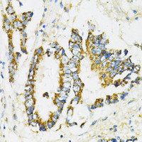 Immunohistochemistry of paraffin-embedded Human colon carcinoma using SERPINE1 Polyclonal Antibody at dilution of 1:100 (40x lens) .