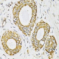 Immunohistochemistry of paraffin-embedded Human breast cancer using SERPINE1 Polyclonal Antibody at dilution of 1:100 (40x lens) .