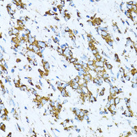 Immunohistochemistry of paraffin-embedded Human gastric cancer using SERPINE1 Polyclonal Antibody at dilution of 1:100 (40x lens) .