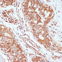 Immunohistochemistry of paraffin-embedded Human mammary cancer using PTPRN2 Polyclonal Antibody at dilution of 1:100 (40x lens) .