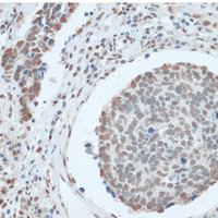 Immunohistochemistry of paraffin-embedded Human lung cancer using ZNF433 Polyclonal Antibody at dilution of 1:100 (40x lens) .