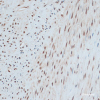 Immunohistochemistry of paraffin-embedded Human uterine cancer using ZNF433 Polyclonal Antibody at dilution of 1:100 (40x lens) .