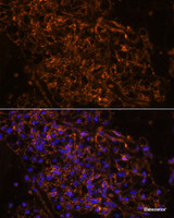 Immunofluorescence analysis of Human kidney cancer using SCNN1G Polyclonal Antibody at dilution of 1:100. Blue: DAPI for nuclear staining.