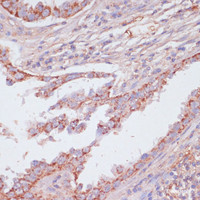 Immunohistochemistry of paraffin-embedded Human lung cancer using ATP5C1 Polyclonal Antibody at dilution of 1:100 (40x lens) .