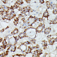 Immunohistochemistry of paraffin-embedded Human thyroid cancer using MANBA Polyclonal Antibody at dilution of 1:100 (40x lens) .