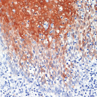 Immunohistochemistry of paraffin-embedded Human tonsil using S100A8 Polyclonal Antibody at dilution of 1:200 (40x lens) .