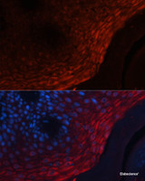 Immunofluorescence analysis of Human skin cancer using S100A8 Polyclonal Antibody at dilution of 1:100 (40x lens) . Blue: DAPI for nuclear staining.