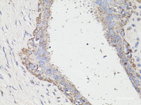 Immunohistochemistry of paraffin-embedded Human breast cancer using LC3A / LC3B Polyclonal Antibody at dilution of 1:100 (40x lens) .