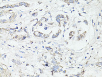 Immunohistochemistry of paraffin-embedded Human gastric cancer using LC3A / LC3B Polyclonal Antibody at dilution of 1:100 (40x lens) .