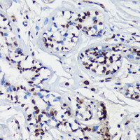 Immunohistochemistry of paraffin-embedded Human breast using p27 KIP 1 Polyclonal Antibody at dilution of 1:100 (40x lens) .