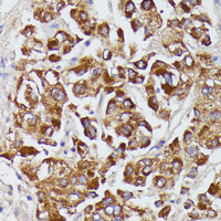 Immunohistochemistry of paraffin-embedded Human liver cancer using AGT Polyclonal Antibody at dilution of 1:100 (40x lens) .