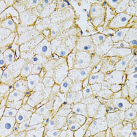 Immunohistochemistry of paraffin-embedded Human liver damage using BSG Polyclonal Antibody at dilution of 1:200 (40x lens) .