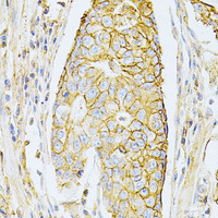 Immunohistochemistry of paraffin-embedded Human gastric cancer using BSG Polyclonal Antibody at dilution of 1:200 (40x lens) .