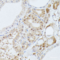 Immunohistochemistry of paraffin-embedded Human thyroid cancer using PPP2R5D Polyclonal Antibody at dilution of 1:100 (40x lens) .