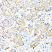 Immunohistochemistry of paraffin-embedded Human liver cancer using HP Polyclonal Antibody at dilution of 1:100 (40x lens) .