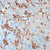 Immunohistochemistry of paraffin-embedded Human liver cancer using HLA-DRA Polyclonal Antibody at dilution of 1:100 (40x lens) .